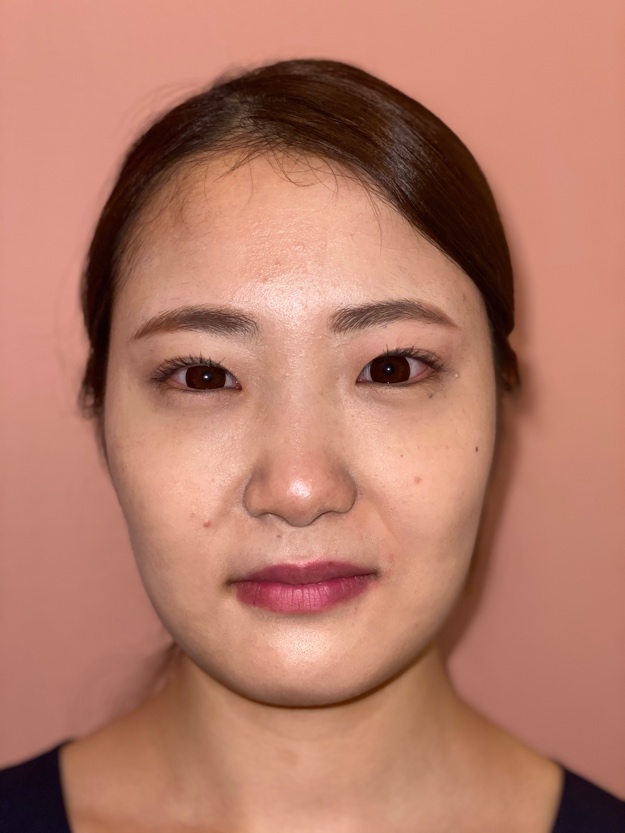 左側の耳下腺マッサージを行った後の状態