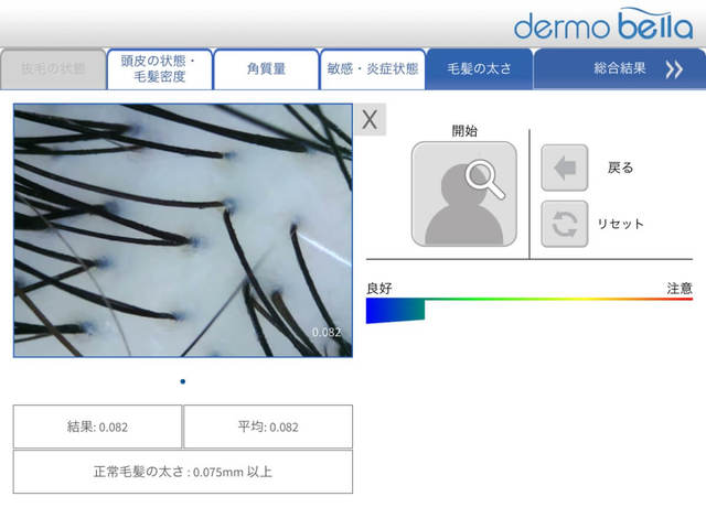 【ヘアメディカルサロン 銀座店】1本の毛穴から2～3本の毛髪が出ているのが健康的な状態